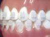 Orthodontics-Brackets