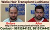 Hair Transplant