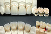 Dental porcelain crown