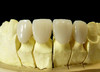Dental PFM-Porcelain fused to Cobalt-Chrome alloy crown and bridge