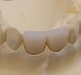 Dental porcelain teeth
