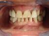 Dental Implants NobelBiocare