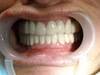 Dental Implants NobelBiocare